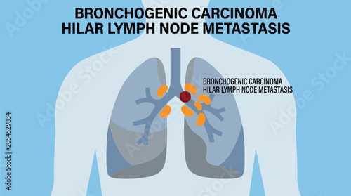 Tableau sur toile Bronchogenic Carcinoma Hilar Lymph Node Metastasis