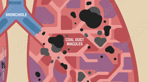 Obraz na plátně Pneumoconiosis Coal Dust Macules in Miner Lung Tissue
