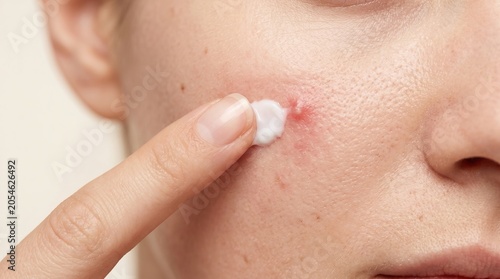 Close Up of Finger Applying Acne Treatment Spot Cream on Red Inflamed Pimple on Cheek