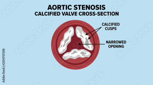 Foto Aortic Stenosis Calcified Valve Cross-Section Illustration