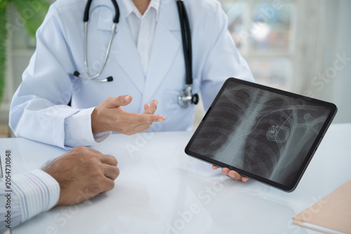 Cuadro en lienzo cardiothoracic surgeon looks medical x-ray image of pacemaker implantation cardioverter defibrillator in chest patient at hospital