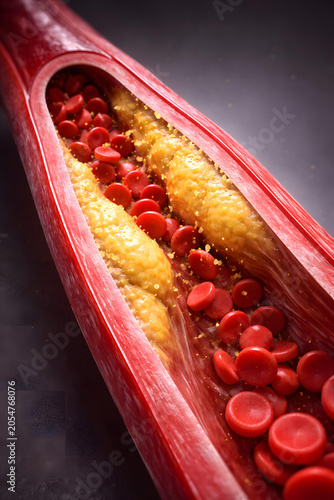 Red blood cell artery plaque cholesterol medical anatomy showing atherosclerosis vessel blockage with red blood cell flow
