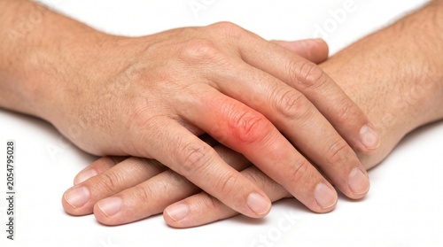 Close-up of hands holding with visible red inflamed joints and skin irritation medical condition