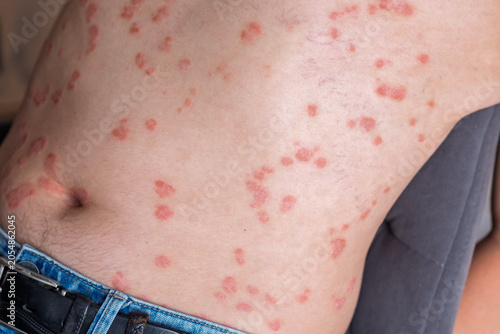 Photos Close-up of a person's back displaying psoriasis with red patches and lesions on
