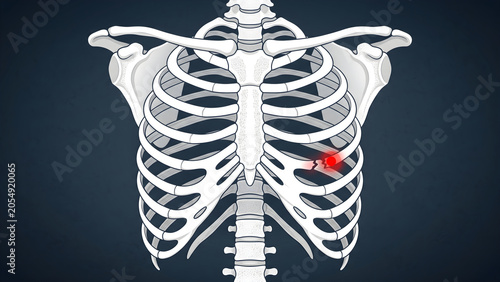Human chest rib cage pain x-ray illustration showing rib inflammation