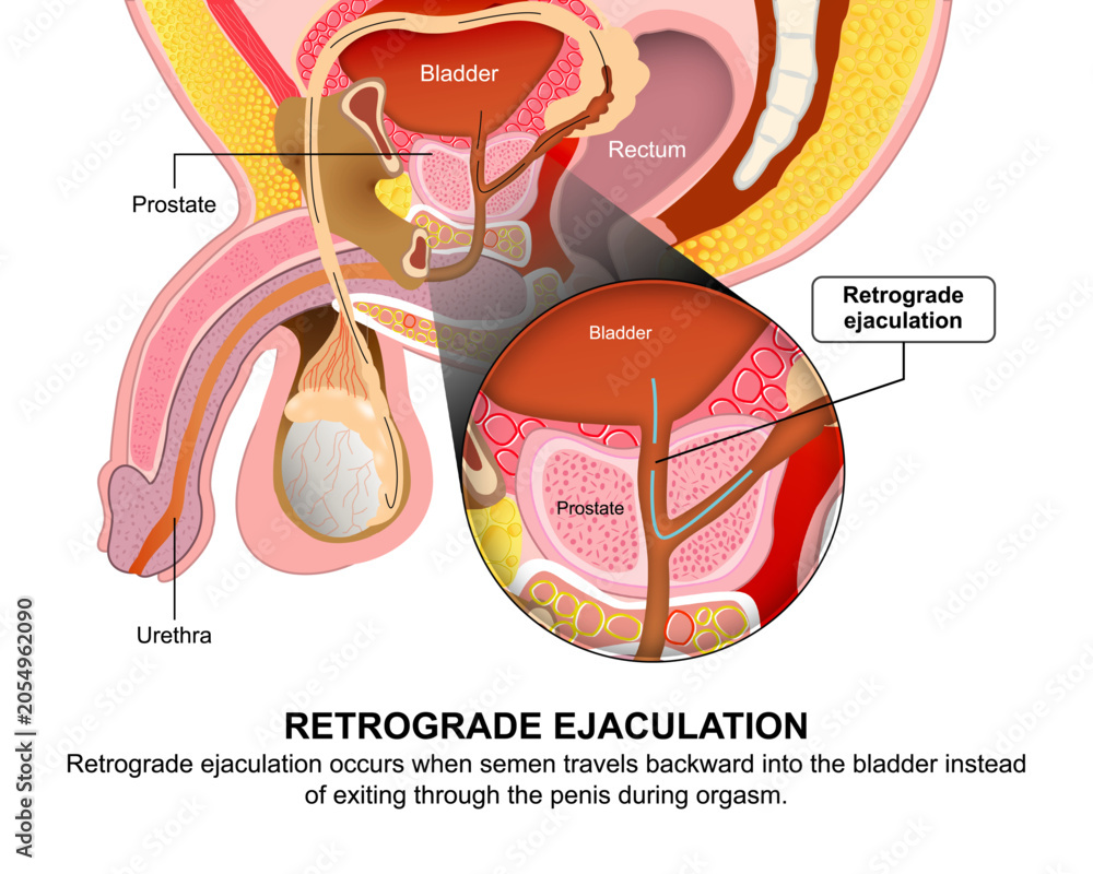 Foto Retrograde Ejaculation, Male Flashcard Illustration