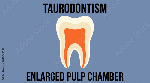 Tableau sur toile Taurodontism Enlarged Pulp Chamber Morphology