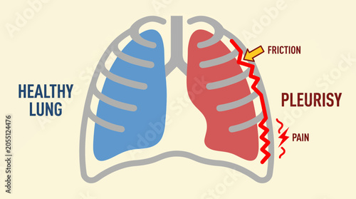 Bild auf Leinwand Pleurisy Inflamed Pleural Membrane with Friction and Pain