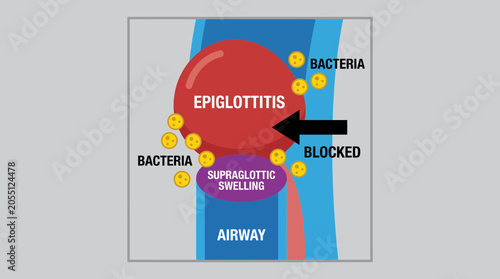 Slika na platnu Epiglottitis Bacterial Swelling Blocking Supraglottic Airway