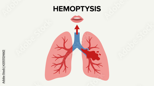 Bild auf Leinwand Hemoptysis Bleeding from Pulmonary Arterial Vessel Rupture