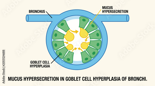 Canvastavla Mucus Hypersecretion in Goblet Cell Hyperplasia of Bronchi