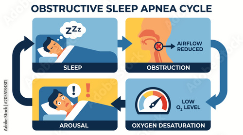 Tableau sur toile Obstructive Sleep Apnea Hypopnea Oxygen Desaturation Cycle