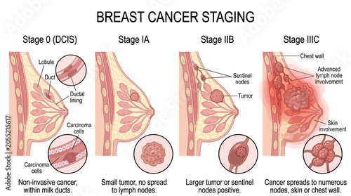 Understanding Breast Cancer Staging From DCIS to Stage III