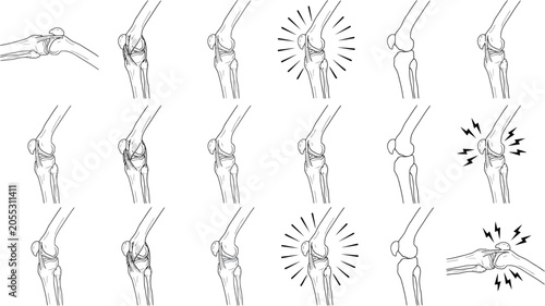 Obraz na płótnie Six knee joint medical diagrams arranged horizontally showing normal anatomy and