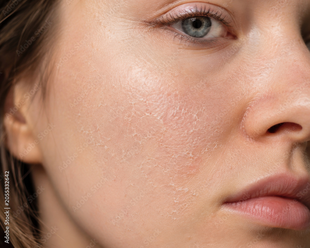 Fototapeta premium Close Up of Dry Flaky Facial Skin on Woman Face Showing Dehydration and Skin Barrier Damage