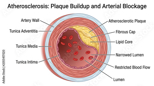 Canvastavla Atherosclerosis causes arterial blockage with plaque buildup inside artery walls