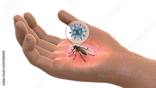 Cuadro en lienzo Isolated human hand showing a biting insect on inflamed skin and a magnified vir