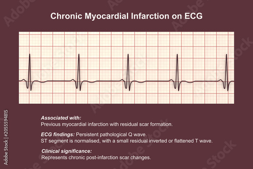 Konstfotografi Electrocardiogram showing chronic Q waves, 3D illustration of ECG trace indicating previous myocardial infarction and established necrotic myocardial scar