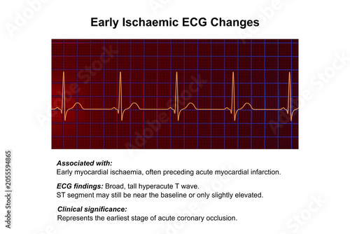 Принти на полотні Electrocardiogram showing hyperacute T waves, 3D illustration of ECG trace indicating early acute myocardial ischemia with tall symmetrical T waves