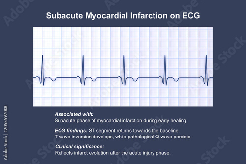 Foto Subacute stage of myocardial infarction, 3D