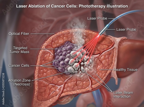 Laser Ablation of Cancer Cells in Liver Phototherapy Medical Illustration