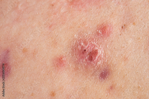 Photos Pimple with visible blemishes