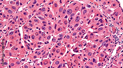 Microscopic view of liver cancer cells in human tissue stained for medical analysis