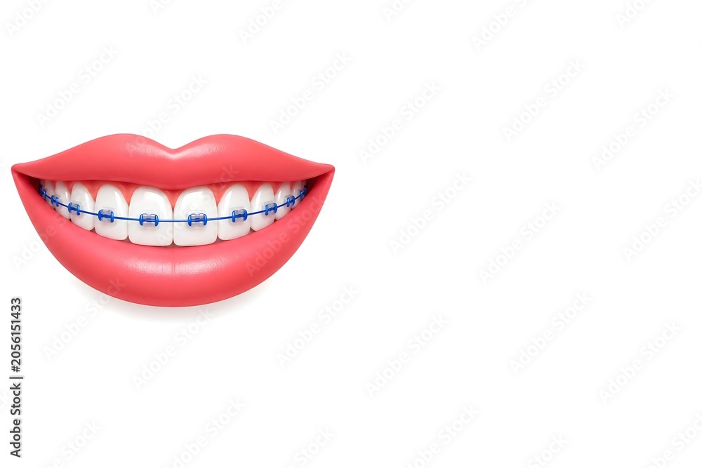 Fototapeta premium Smile with Blue Dental Braces on White Background, Realistic Orthodontic Treatment Concept. Copyspace