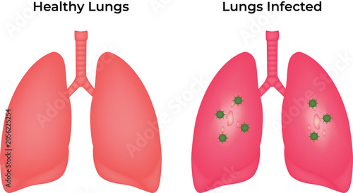 Healthy Lungs vs. Infected Lungs Illustration