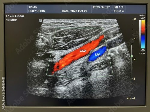 Ultrasound scan showing blood flow in heart chambers