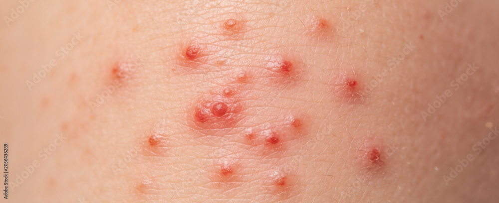 Fototapeta premium Close-up of measles rash with small red bumps on skin of child. Symptoms of viral infection and childhood disease. Dermatological condition and medical health concept for skin irritation.
