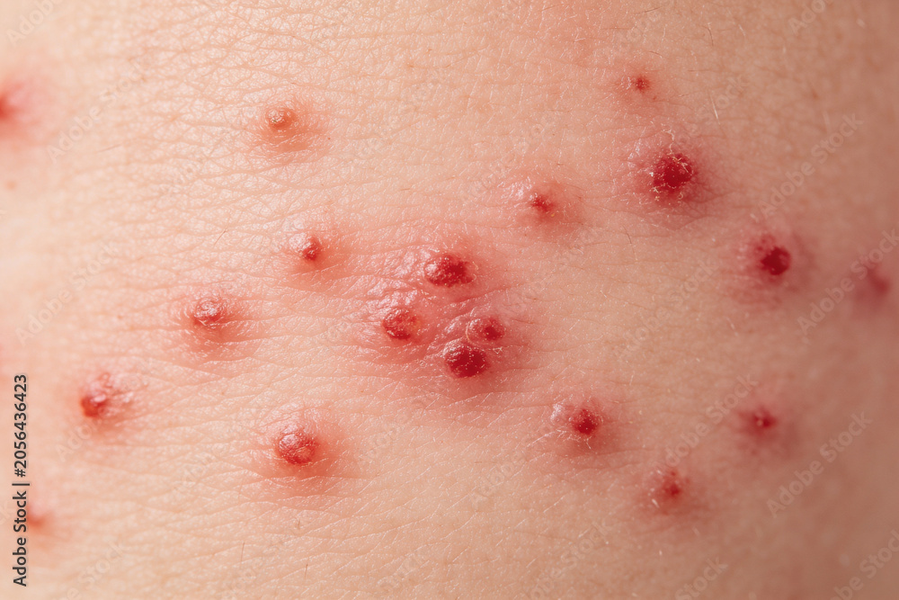 Fototapeta premium Skin rash with red pimples on human body. Close up of measles symptom on kid skin. Viral infection and outbreak awareness. Dermatology concept for medical study and patient treatment.
