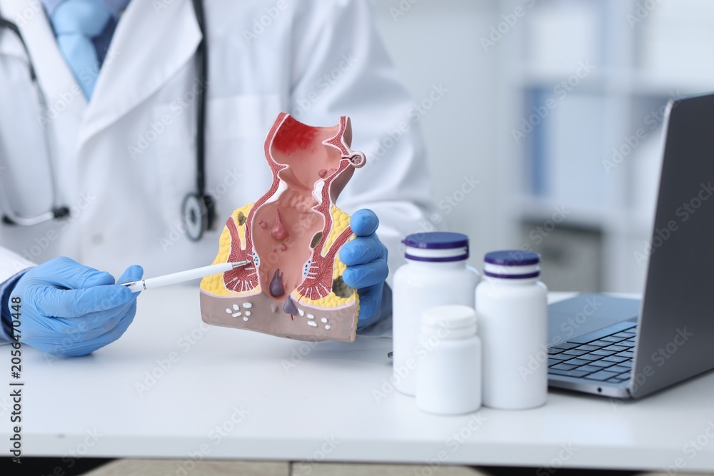 Anal fissure treatment