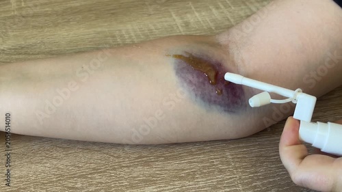 sizzling spraying liquid medicine on human skin