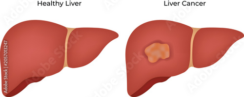 Healthy Liver and Liver Cancer Comparison Illustration