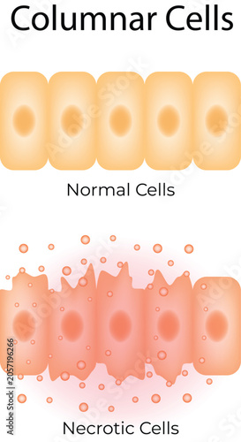 Columnar Cells Normal and Necrotic Comparison Illustration