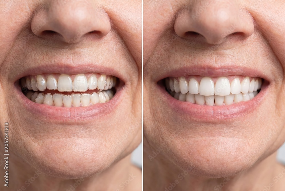 Fototapeta premium Split image showing a woman's smile before and after orthodontic treatment with clear aligners for straighter teeth.