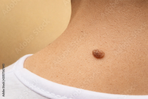 Konstfotografi Close-Up Macro Of Benign Skin Mole For Medical Dermatology Examination