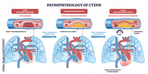 Bild auf Leinwand Pathophysiology of CTEPH depicts embolus becoming organized thrombus, narrowing pulmonary arteries and causing right ventricular strain, vessels, lungs, heart
