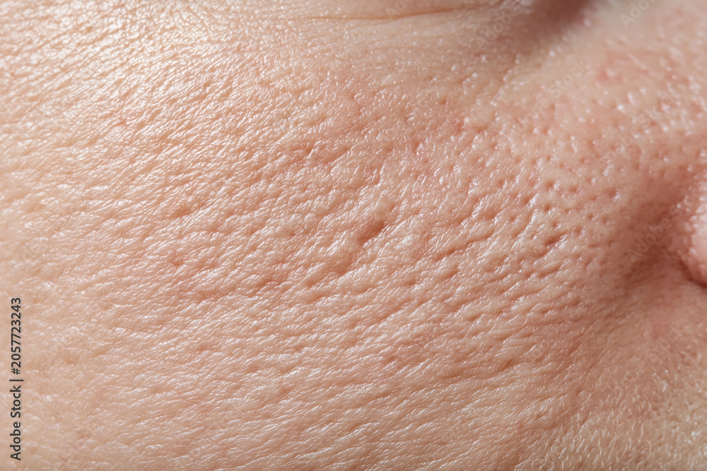 Fototapeta premium Macro close up of facial skin with visible pores acne marks and uneven tone showing natural texture and soft lighting