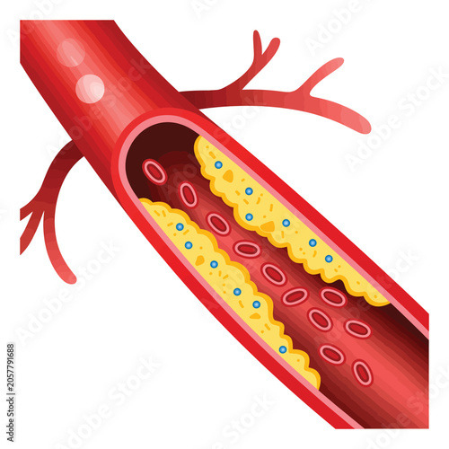 Konstfotografi Medical showing atherosclerosis with plaque buildup inside a human artery restri