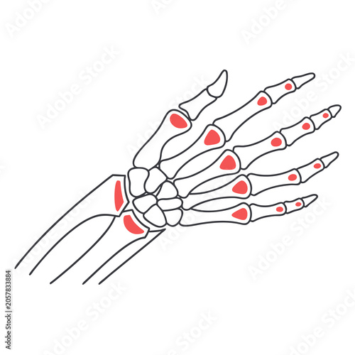 Fotografi Anatomical illustration of a human hand skeleton showing inflamed joints, indicative of arthritis or a similar medical condition