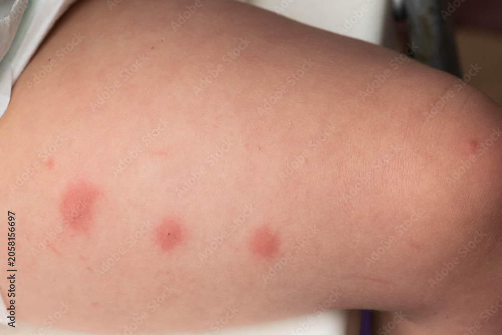Fototapeta premium Mosquito bites on toddler leg with red skin reaction close up