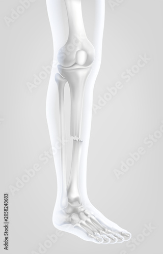 3D medical illustration human leg skeleton side profile showing  fracture ideal orthopedic trauma and healthcare