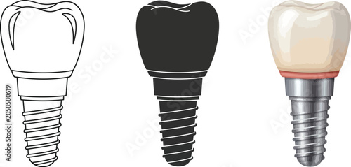 Εκτύπωση καμβά Dental implant illustration showing screw abutment and crown in outline silhouet