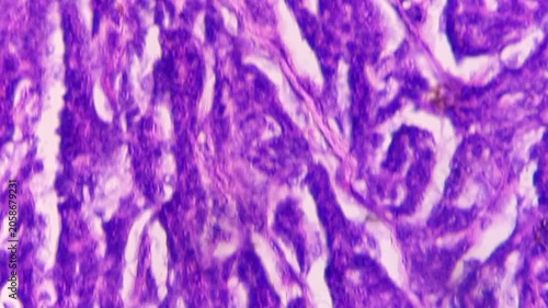 Histopathology of right breast lump. Infiltrating ductal carcinoma (nst), well differentiated G-1. Section of breast tumour reveal features of an infiltrating ductal carcinoma. 