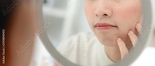 Foto Woman worried about face Dermatology, rosacea dermatitis, allergic steroids, sen