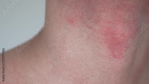 A man’s neck showing skin redness, irritation and razor burn after shaving. Visible beard stubble and inflamed skin highlight common grooming-related skin sensitivity and post-shave irritation