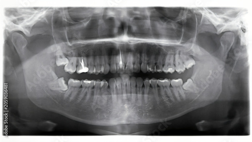 Schilderij op canvas Panoramic dental x-ray showing full mouth teeth and jaw structure for oral healt