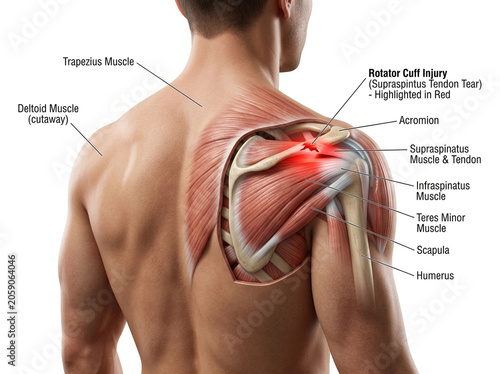 Anatomical illustration of a human shoulder with highlighted rotator cuff injury and labeled muscles on white background